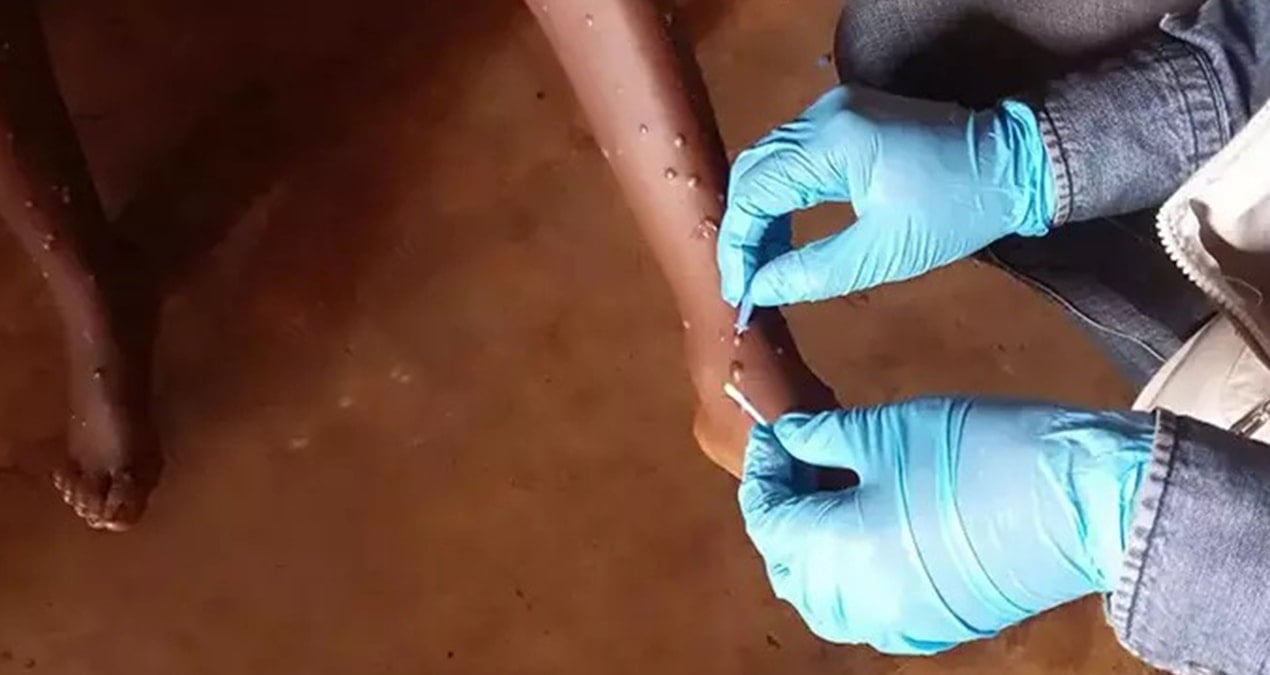 Uganda’da maymun çiçeği kabusu: Vaka sayısı artıyor